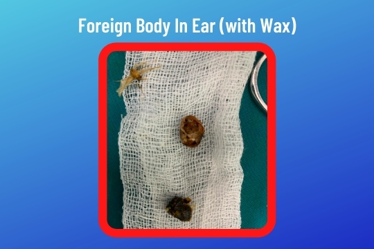 Foreign Body Removal From Ear, Nose Throat
